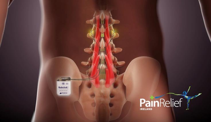 New technology to treat chronic lower back pain